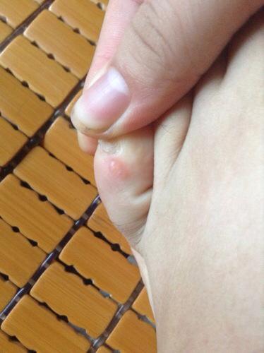 脚上起小水泡很痒是怎么回事：脚上起小水泡很痒？5大常见原因与科学应对指南