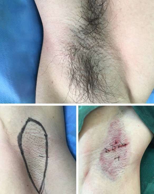 狐臭微创手术价格：狐臭微创手术价格参考，了解费用与选择建议