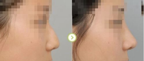 肋骨隆鼻三个月变化图:肋骨隆鼻三个月变化图,术后恢复关键期的蜕变与效果初显