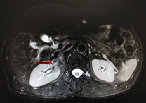 最难治的10大肿瘤：生命禁区」的终极挑战，全球公认最难治的10大肿瘤，生存率低到令人绝望！