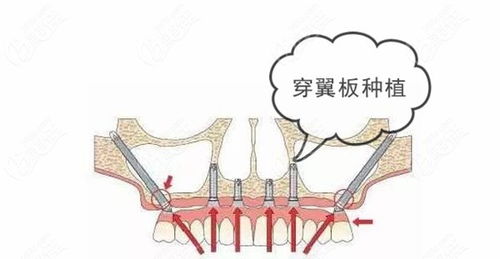 种植牙视频直播全过程：揭秘种植牙视频直播全过程，透明、互动、专业，带你全方位了解种植牙手术！