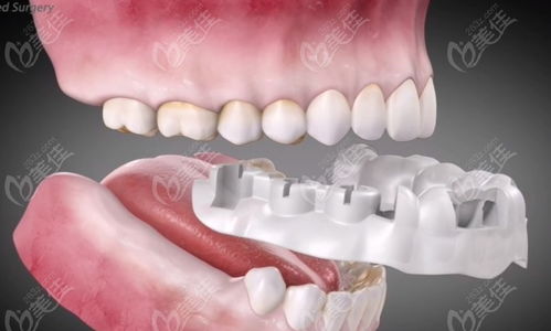 种植牙视频直播全过程:揭秘种植牙视频直播全过程,透明、互动、专业,带你全方位了解种植牙手术! 种植牙视频直播全过程:揭秘种植牙视频直播全过程,透明、互动、专业,带你全方位了解种植牙手术!