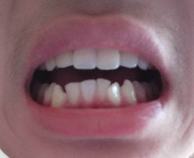 18岁戴牙套会不会太晚:18岁戴牙套会不会太晚?答案来了! 18岁戴牙套会不会太晚:18岁戴牙套会不会太晚?答案来了!