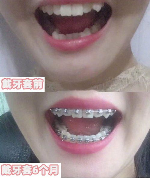 18岁戴牙套会不会太晚:18岁戴牙套会不会太晚?答案来了! 18岁戴牙套会不会太晚:18岁戴牙套会不会太晚?答案来了!