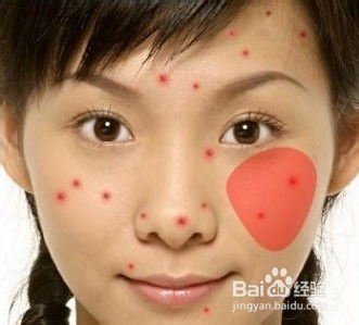 怎样快速去除脸上痘痘:告别恼人痘痘!快速去除脸上痘痘的实用指南