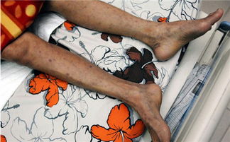 艾滋三年内必有症状:艾滋病三年内必有症状?揭开潜伏期的真相 艾滋三年内必有症状:艾滋病三年内必有症状?揭开潜伏期的真相