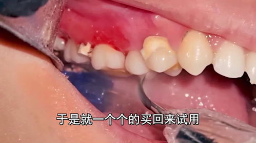 清理牙结石多少钱一次:牙结石清理一次要多少钱?看完这篇你就懂了!