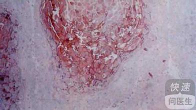 痤疮图片：透过痤疮图片读懂肌肤警讯