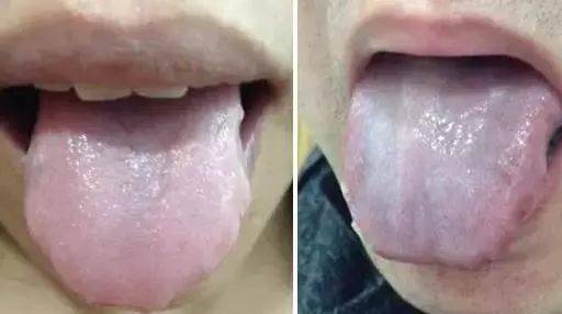 舌头发白警惕三种病：舌头发白要警惕？这三种疾病可能在作祟