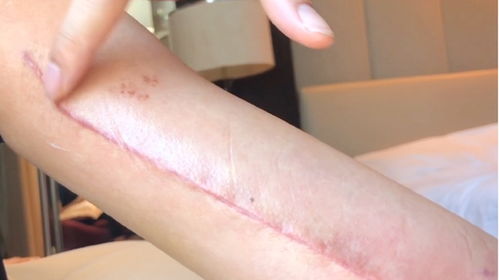 皮肤擦破皮了最快恢复方法不留疤:皮肤擦破后的急救处理,不留疤痕的快速恢复指南 皮肤擦破皮了最快恢复方法不留疤:皮肤擦破后的急救处理,不留疤痕的快速恢复指南