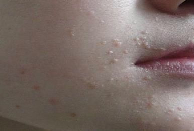 皮肤擦破皮了最快恢复方法不留疤:皮肤擦破后的急救处理,不留疤痕的快速恢复指南 皮肤擦破皮了最快恢复方法不留疤:皮肤擦破后的急救处理,不留疤痕的快速恢复指南