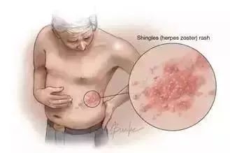 治疗疱疹最好方法:疱疹困扰?专家解析,科学认知与综合治疗是关键