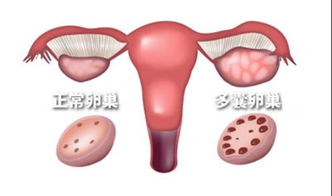 卵巢多囊手术大概多少钱:卵巢多囊手术全解析,费用构成与影响因素 卵巢多囊手术大概多少钱:卵巢多囊手术全解析,费用构成与影响因素