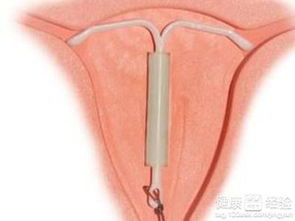上环10年了取环疼吗：上环10年了取环疼吗？医生详解取环过程与疼痛应对方法
