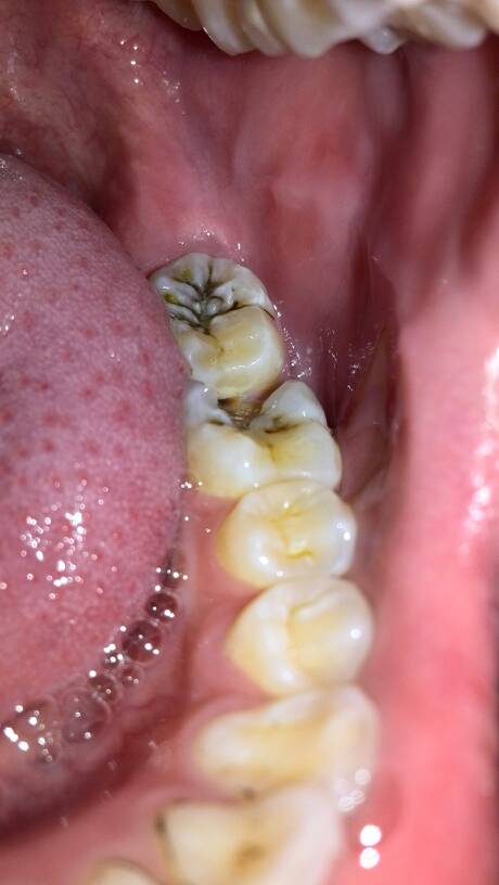 智齿长出一半被肉包着肿痛怎么办：智齿长出一半被肉包着还肿痛？这些应急处理和就医建议请收好！