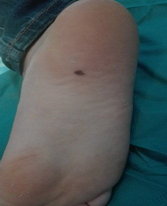 面部最好的三颗痣:面部三颗吉痣的传说与科学,从民俗寓意到医学视角的解读 面部最好的三颗痣:面部三颗吉痣的传说与科学,从民俗寓意到医学视角的解读