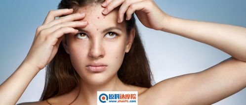 15岁长青春痘需要治疗吗：15岁长青春痘需要治疗吗？这些情况要注意！