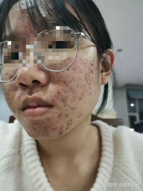 15岁长青春痘需要治疗吗:15岁长青春痘需要治疗吗?这些情况要注意! 15岁长青春痘需要治疗吗:15岁长青春痘需要治疗吗?这些情况要注意!