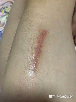 怎样辨别皮肤病是哪种病：皮肤出现异常？这些症状帮你快速识别常见皮肤病