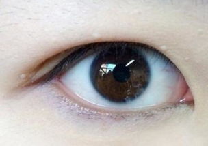 双眼皮全切：双眼皮全切，了解手术全过程，重获理想双眼皮形态