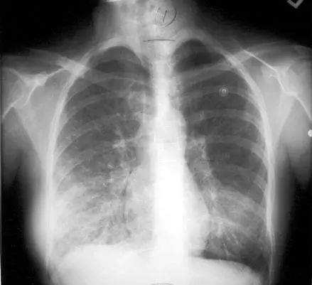 一般肺炎可以自愈吗:肺炎真的可以自愈吗?这些情况要警惕! 一般肺炎可以自愈吗:肺炎真的可以自愈吗?这些情况要警惕!