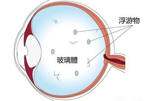 一千度以上近视眼可以手术吗：高度近视（1000度以上）能手术吗？权威解答与注意事项