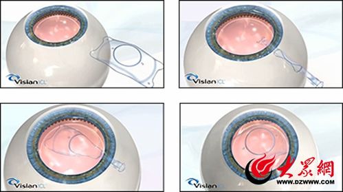 一千度以上近视眼可以手术吗：高度近视（1000度以上）能手术吗？权威解答与注意事项