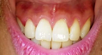 牙龈萎缩居然自然恢复了：牙龈萎缩居然自然恢复了！这些方法你也能试试