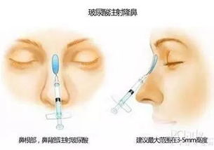 鼻子塌怎么办:鼻子塌了怎么办?重塑挺拔鼻梁的多种方法与注意事项 鼻子塌怎么办:鼻子塌了怎么办?重塑挺拔鼻梁的多种方法与注意事项