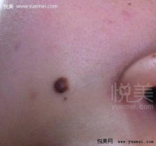 点痣多少钱一颗正规医院:正规医院点痣一颗多少钱?全面解析与价格参考! 点痣多少钱一颗正规医院:正规医院点痣一颗多少钱?全面解析与价格参考!