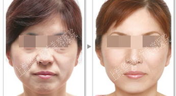 快速去掉老年斑的方法：告别岁月痕迹！这些方法或可有效快速淡化老年斑