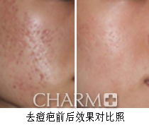 快速去掉老年斑的方法:告别岁月痕迹!这些方法或可有效快速淡化老年斑 快速去掉老年斑的方法:告别岁月痕迹!这些方法或可有效快速淡化老年斑