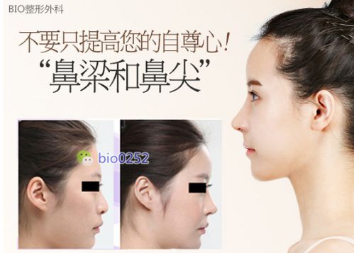 弄鼻子需要多少钱：弄鼻子需要多少钱？单鼻翼缩小与隆鼻手术费用全解析