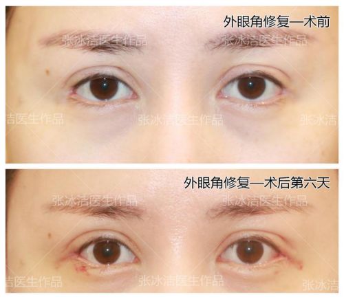 眼睑外翻自己恢复好了：神奇！我的眼睑外翻竟然自己恢复好了，分享几个关键自救方法