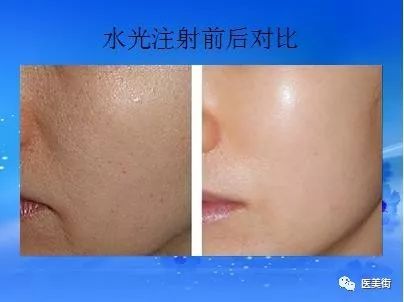 水光针一旦停了会老得快吗：水光针一旦停了会老得快吗？真相揭秘！