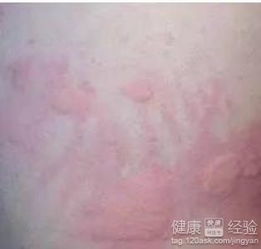 病毒性湿疹的图片:警惕病毒性湿疹,识别与防治指南 病毒性湿疹的图片:警惕病毒性湿疹,识别与防治指南