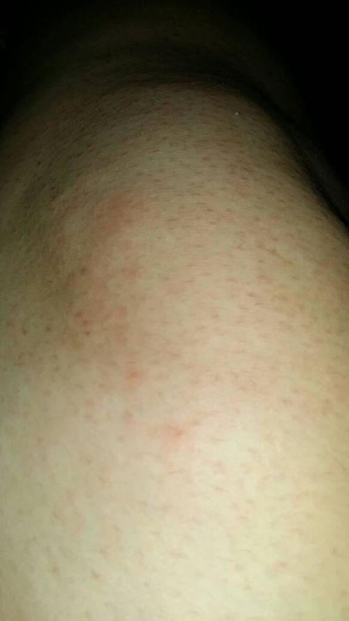 过敏一般几天能恢复：过敏恢复期，了解症状与恢复时间