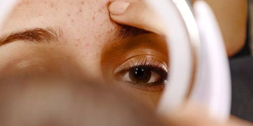 麦粒肿用什么药最管用：麦粒肿用什么药最管用？这些药物和方法帮你快速缓解不适