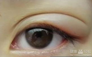 麦粒肿用什么药最管用：麦粒肿用什么药最管用？这些药物和方法帮你快速缓解不适