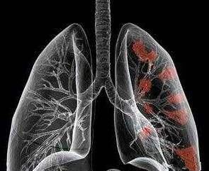 肺部有肿瘤一般会哪里痛：肺癌疼痛，这些部位最常被忽略的警示信号