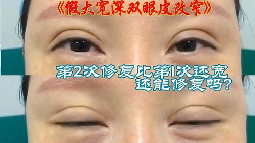 眼下纹特别深怎么消除：眼下纹特别深怎么办？多管齐下，重拾明亮双眸