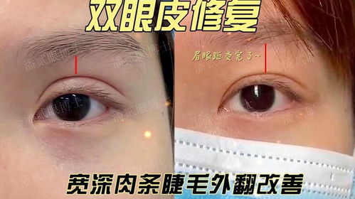 眼下纹特别深怎么消除：眼下纹特别深怎么办？多管齐下，重拾明亮双眸