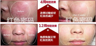 脸上红血丝怎么去除效果好：脸上红血丝怎么去除效果好？专业解析与有效方案