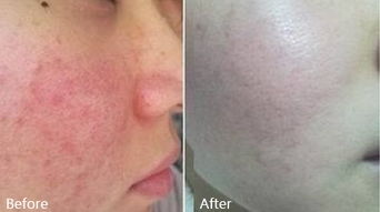 脸上红血丝怎么去除效果好:脸上红血丝怎么去除效果好?专业解析与有效方案 脸上红血丝怎么去除效果好:脸上红血丝怎么去除效果好?专业解析与有效方案