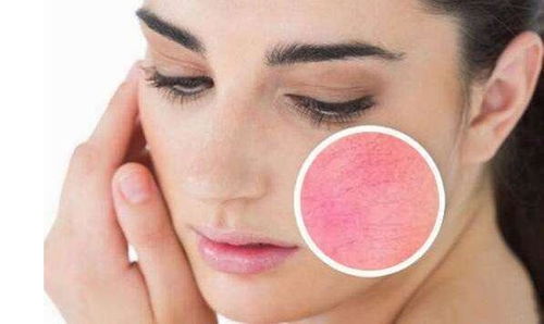 脸上红血丝怎么去除效果好:脸上红血丝怎么去除效果好?专业解析与有效方案 脸上红血丝怎么去除效果好:脸上红血丝怎么去除效果好?专业解析与有效方案