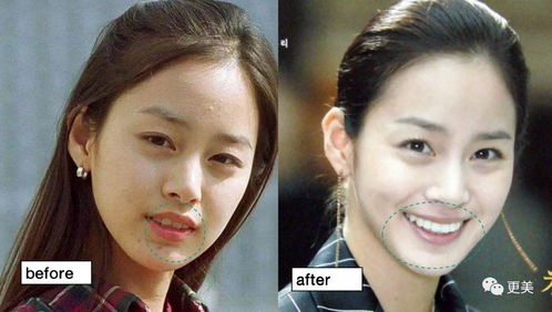 16岁可以整鼻子吗：16岁整鼻子？法律与健康的双重门槛