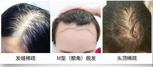 梦见头发秃顶是什么征兆：梦里头发秃了？这些征兆你了解吗