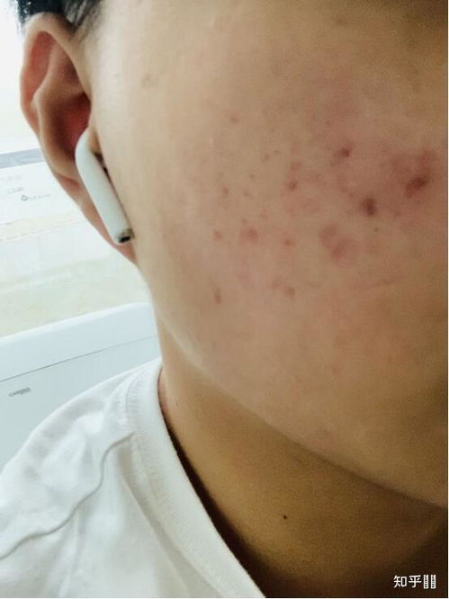 男性两侧长痘痘要警惕：男性两侧长痘痘要警惕，这可能是身体发出的危险信号