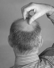 梦见自己头发掉光了：梦里头发全掉光了，醒来后我该担心吗？