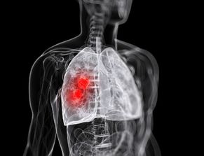 喉咙痒了一个月肺癌:警惕!喉咙痒一个月可能是肺癌信号,这些症状需重视 喉咙痒了一个月肺癌:警惕!喉咙痒一个月可能是肺癌信号,这些症状需重视